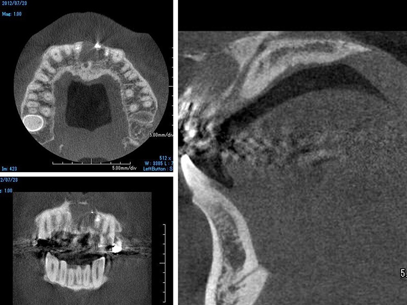 CT画像診断を活用した歯科治療のメリット